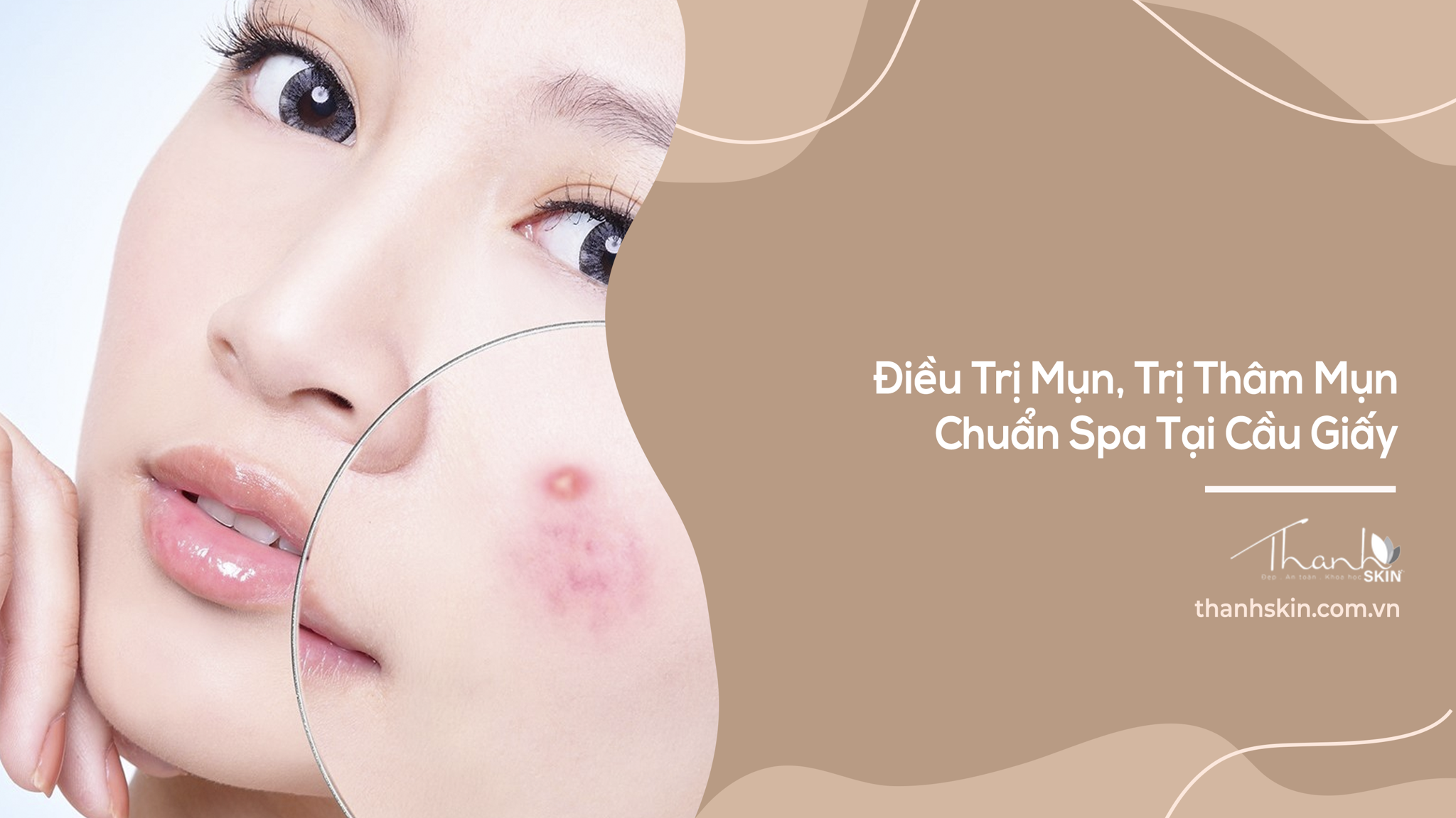 Điều Trị Mụn, Trị Thâm Mụn Chuẩn Spa Tại Cầu Giấy