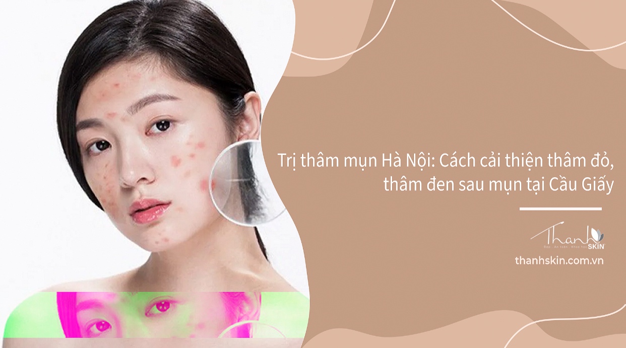 Trị thâm mụn Hà Nội: Cách cải thiện thâm đỏ, thâm đen sau mụn tại Cầu Giấy