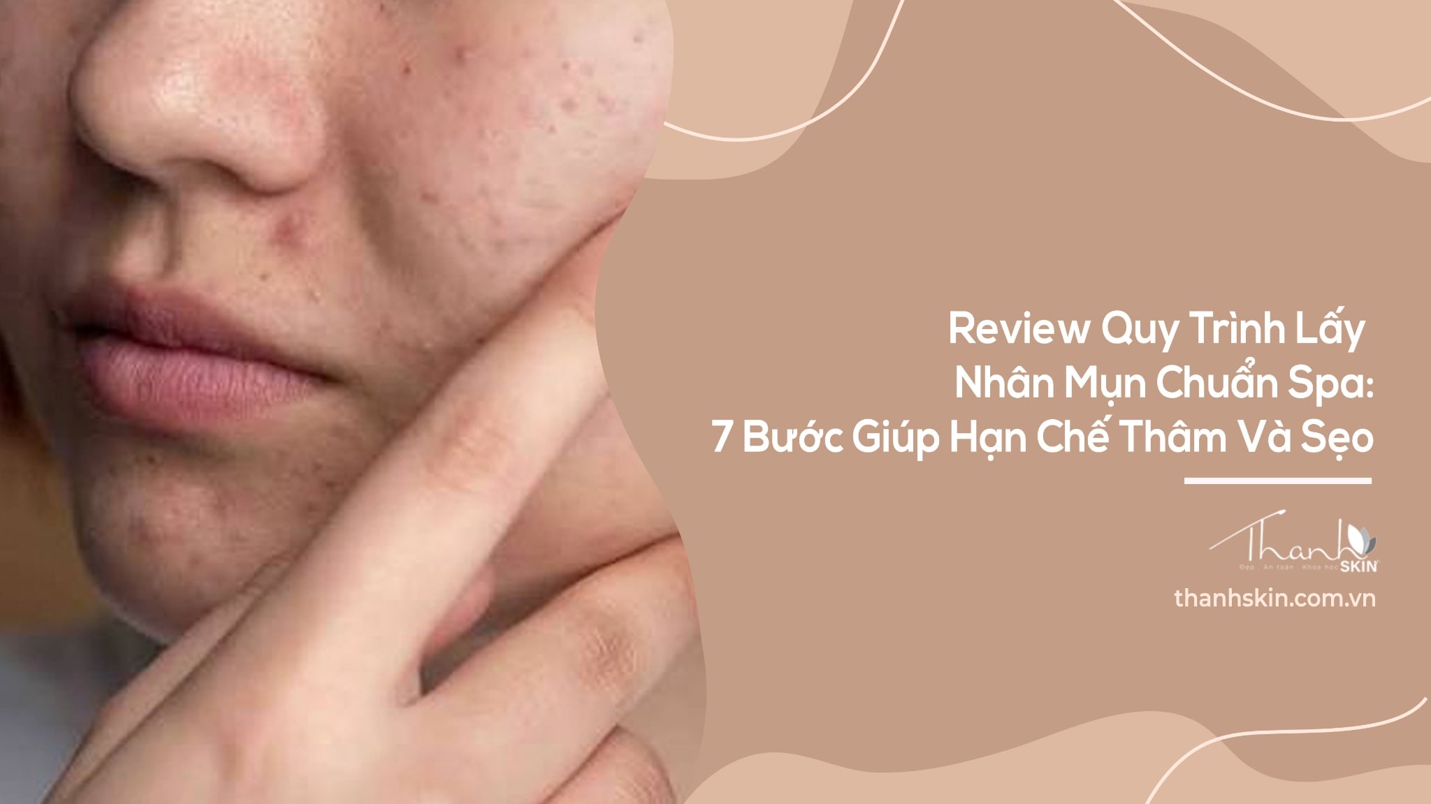 Review Quy Trình Lấy Nhân Mụn Chuẩn Spa: 7 Bước Giúp Hạn Chế Thâm Và Sẹo