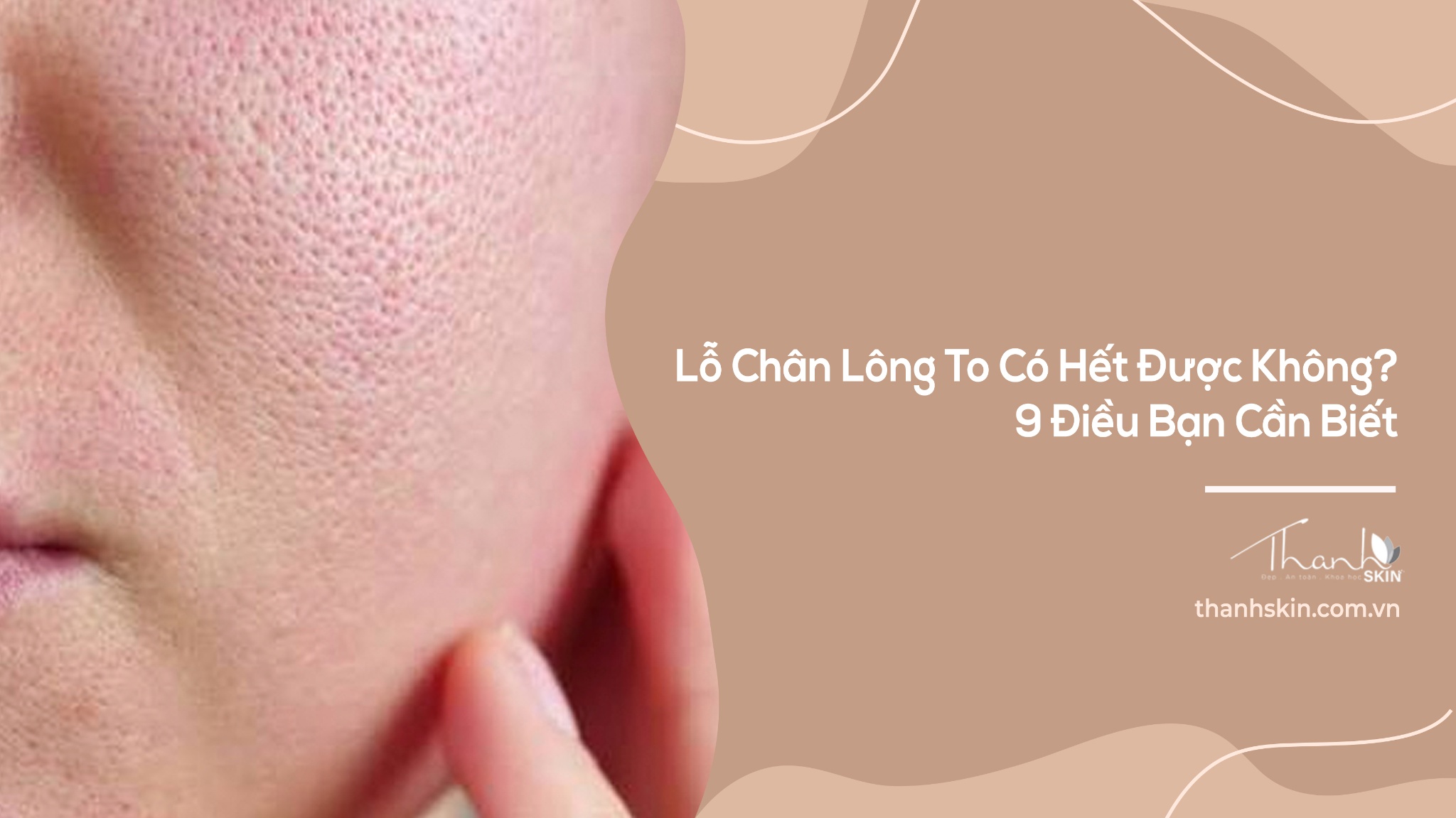 Lỗ Chân Lông To Có Hết Được Không? 9 Điều Bạn Cần Biết