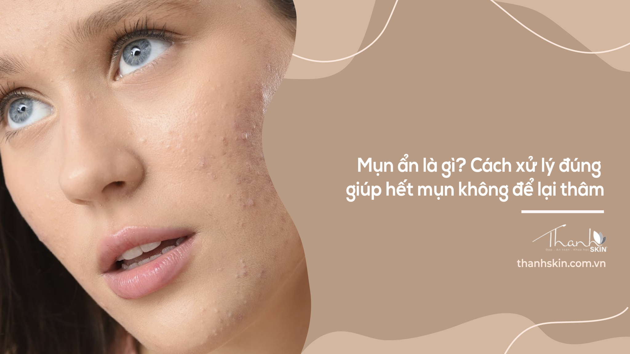 Mụn ẩn là gì? Cách xử lý đúng không để lại thâm