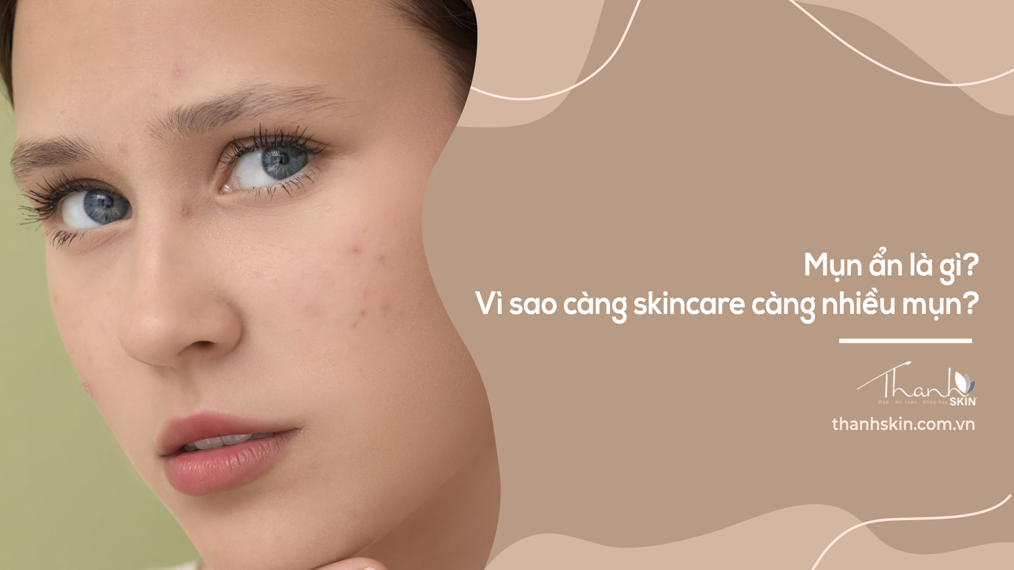Mụn ẩn là gì? Vì sao càng skincare càng nhiều mụn?