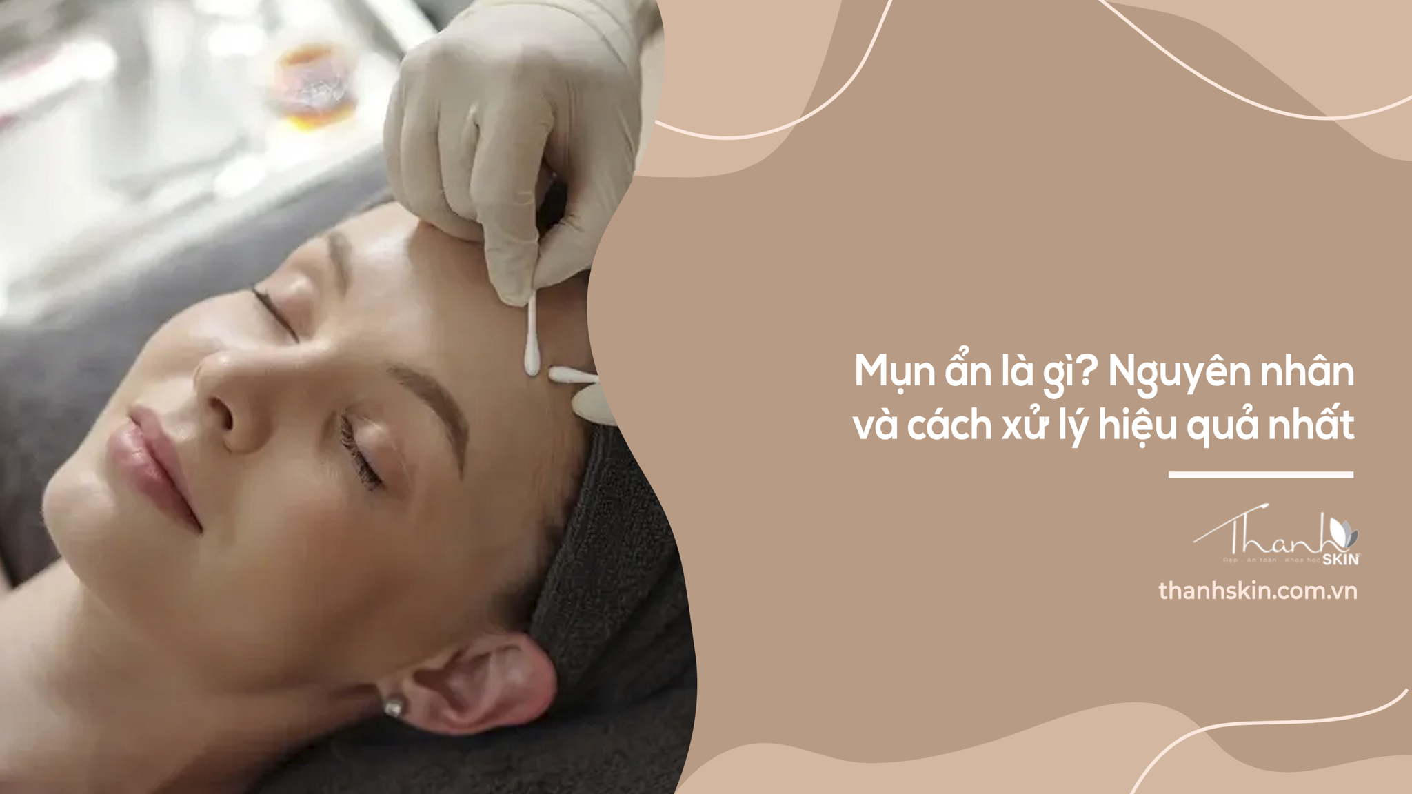 Mụn ẩn – nguyên nhân và cách xử lý hiệu quả