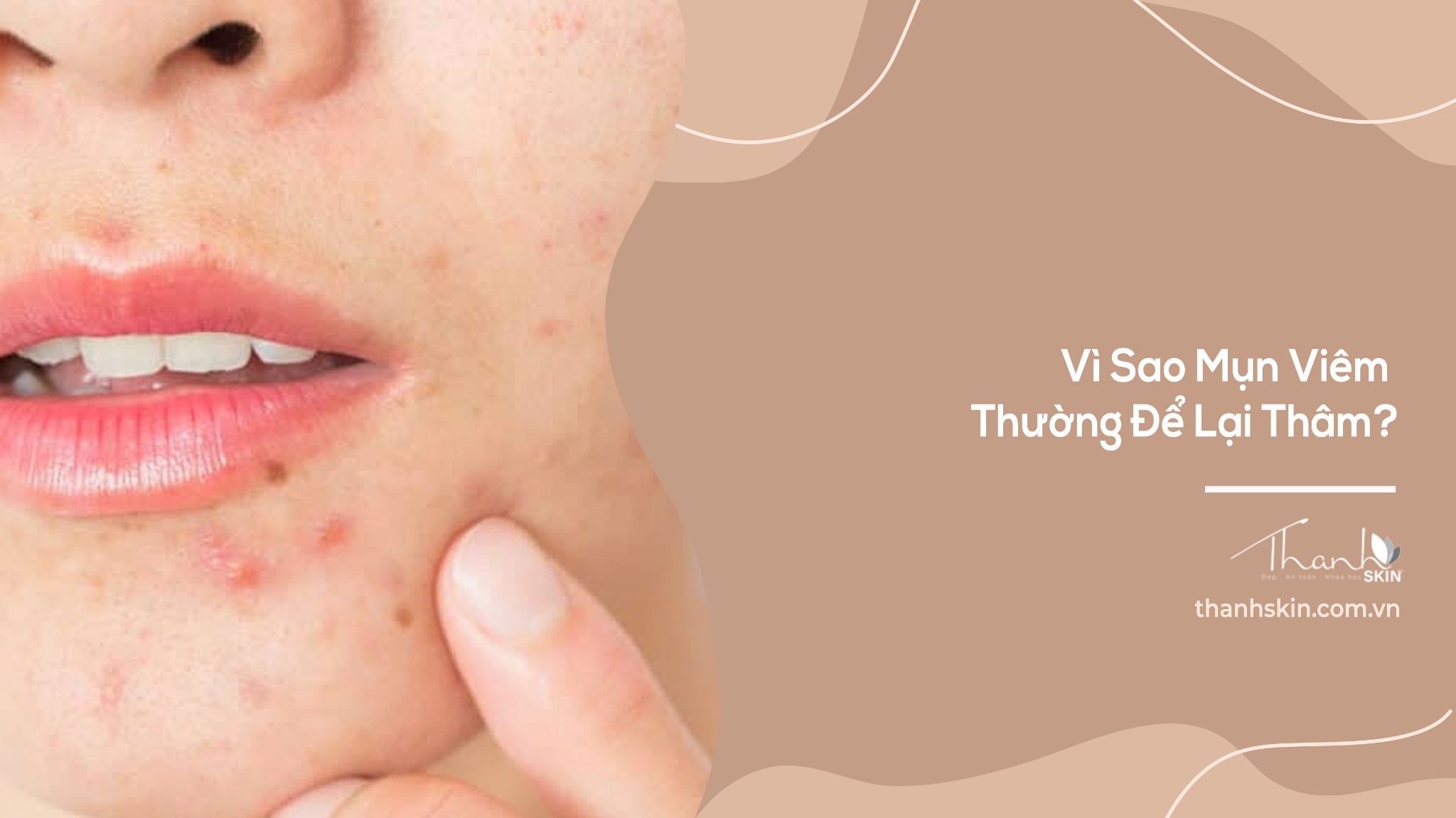 Vì Sao Mụn Viêm Thường Để Lại Thâm?