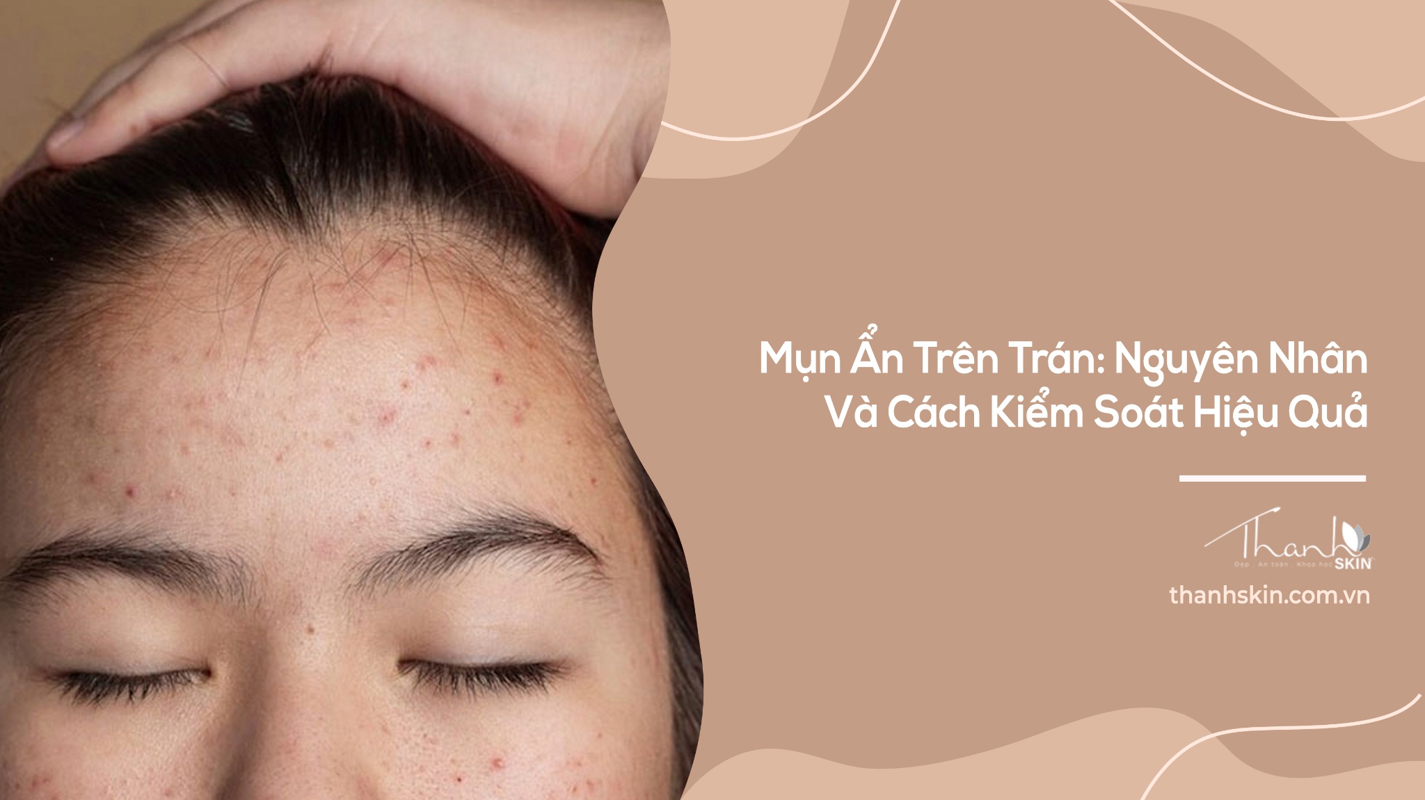 Mụn Ẩn Trên Trán: Nguyên Nhân Và Cách Kiểm Soát Hiệu Quả