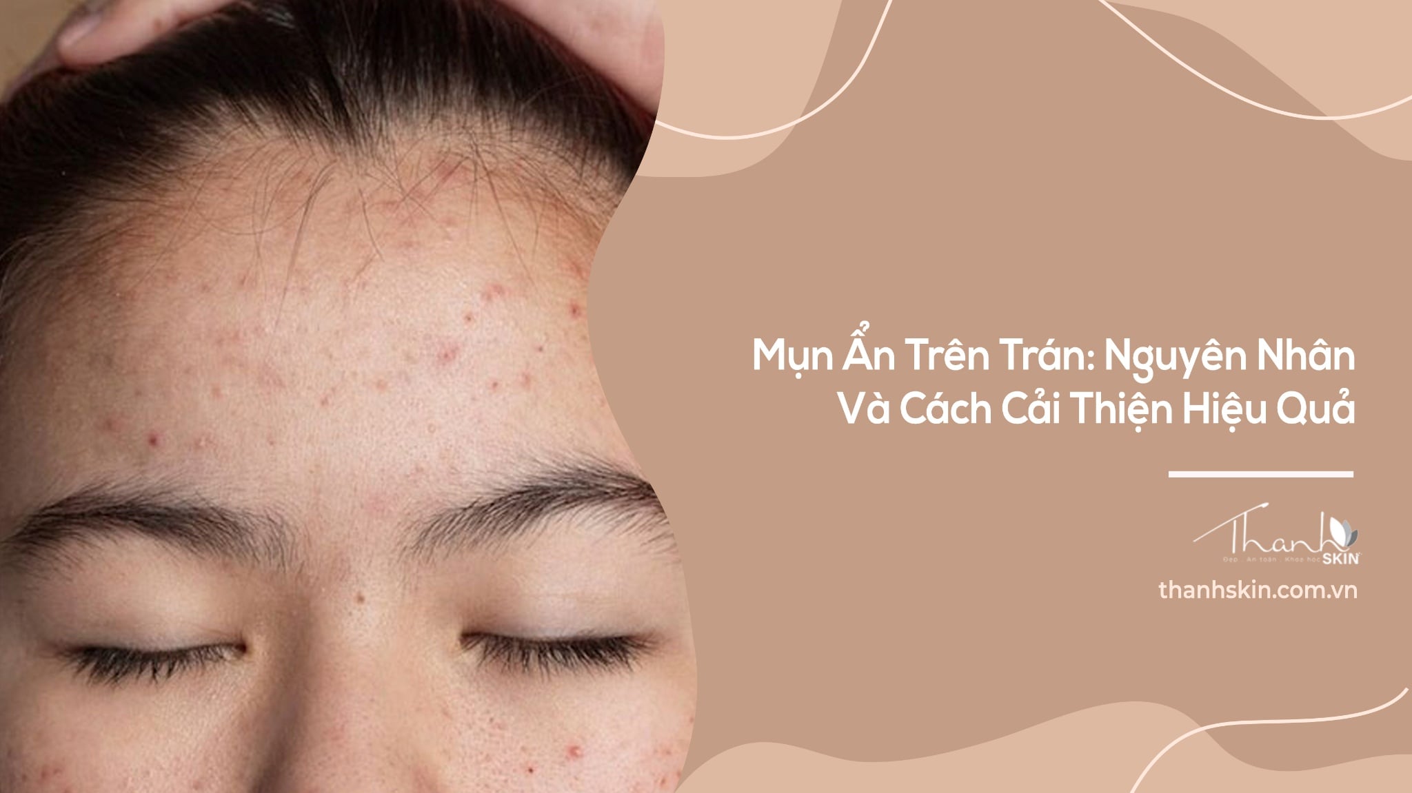Mụn Ẩn Trên Trán: Nguyên Nhân Và Cách Cải Thiện Hiệu Quả