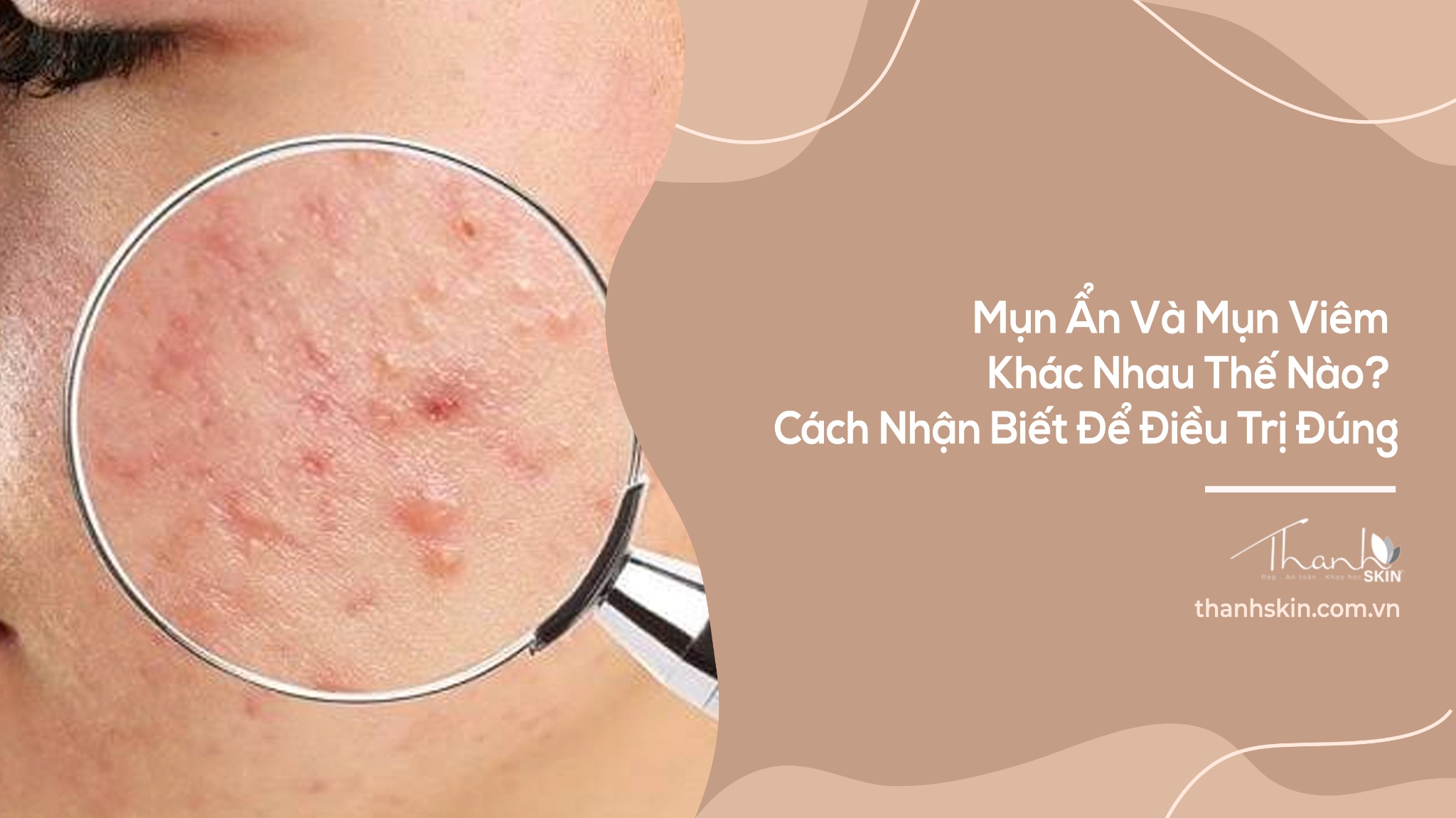 Mụn Ẩn Và Mụn Viêm Khác Nhau Thế Nào? Cách Nhận Biết Để Điều Trị Đúng