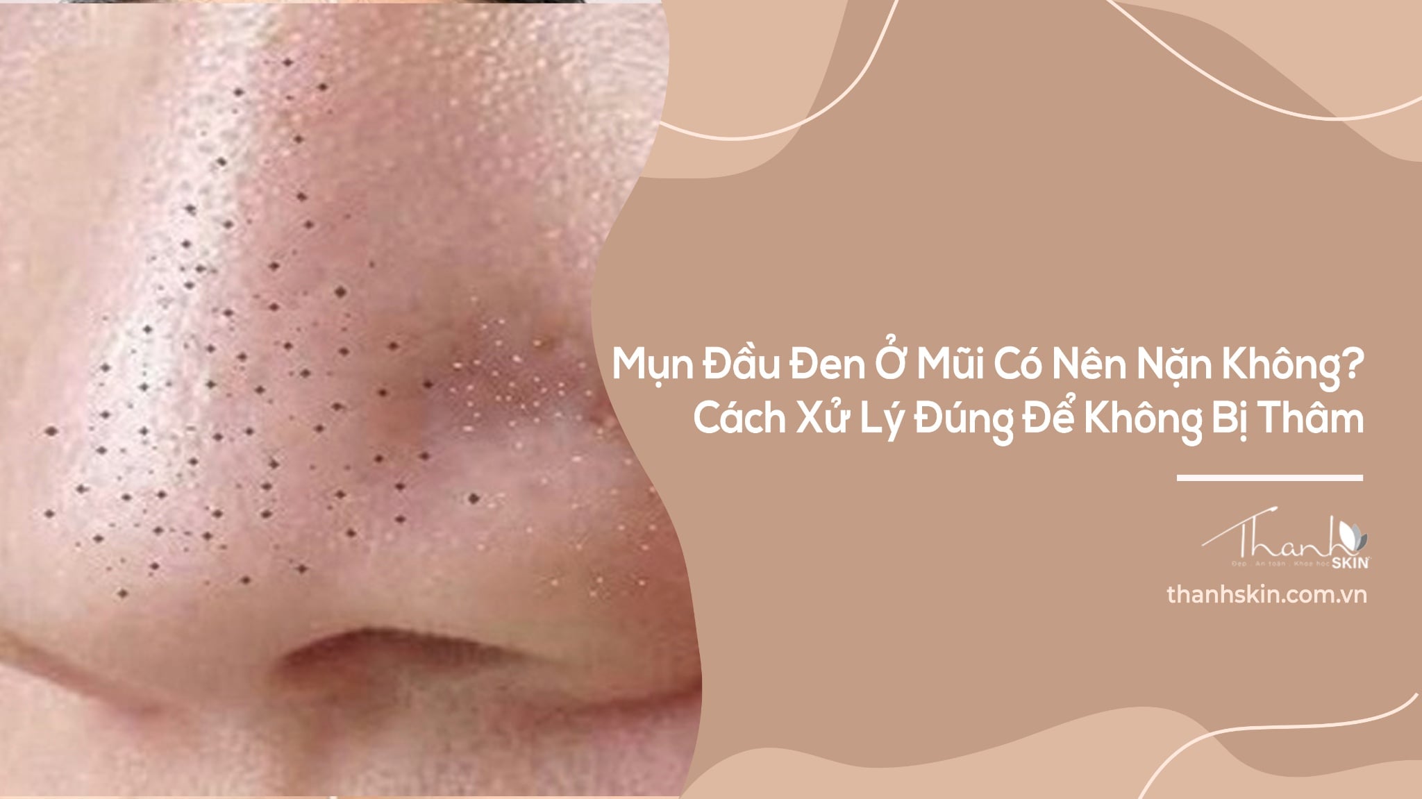 Mụn Đầu Đen Ở Mũi: Nguyên Nhân Và Cách Giảm Hiệu Quả