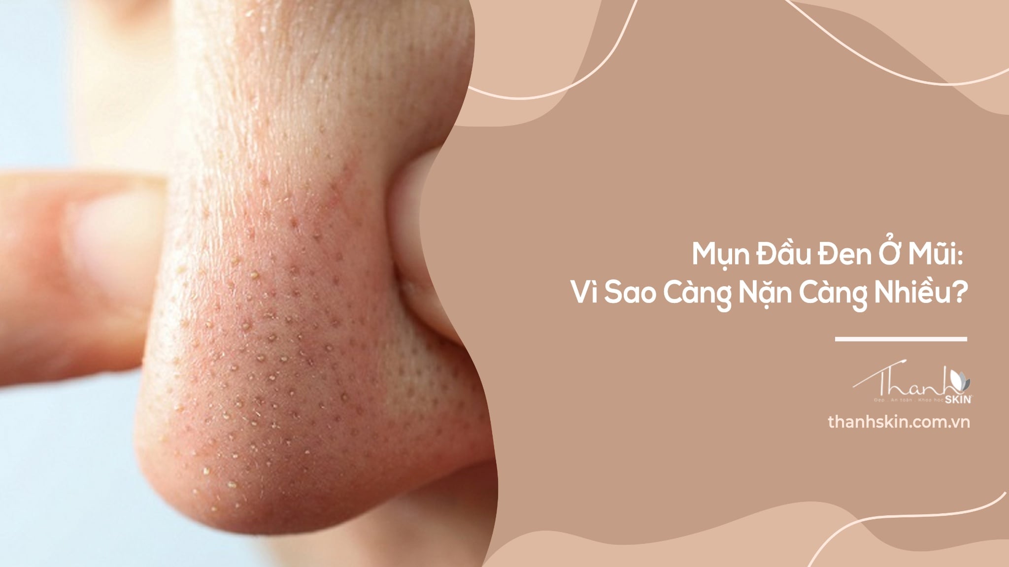 Mụn Đầu Đen Ở Mũi: Vì Sao Càng Nặn Càng Nhiều?