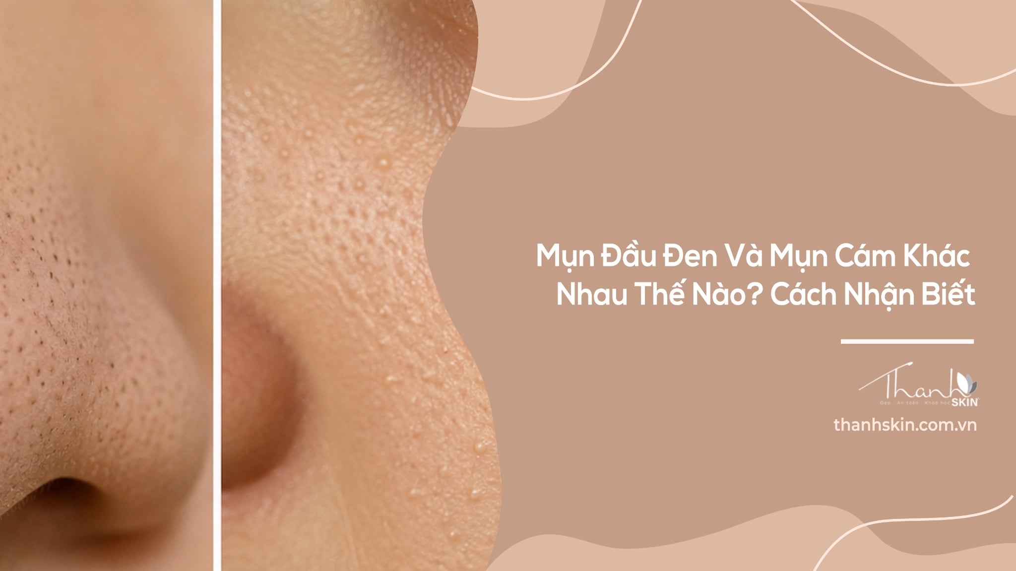 Mụn Đầu Đen Và Mụn Cám Khác Nhau Thế Nào? Cách Nhận Biết