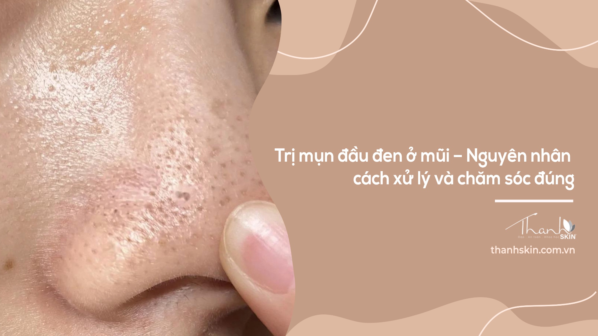 Trị mụn đầu đen ở mũi – Nguyên nhân, cách xử lý và chăm sóc đúng