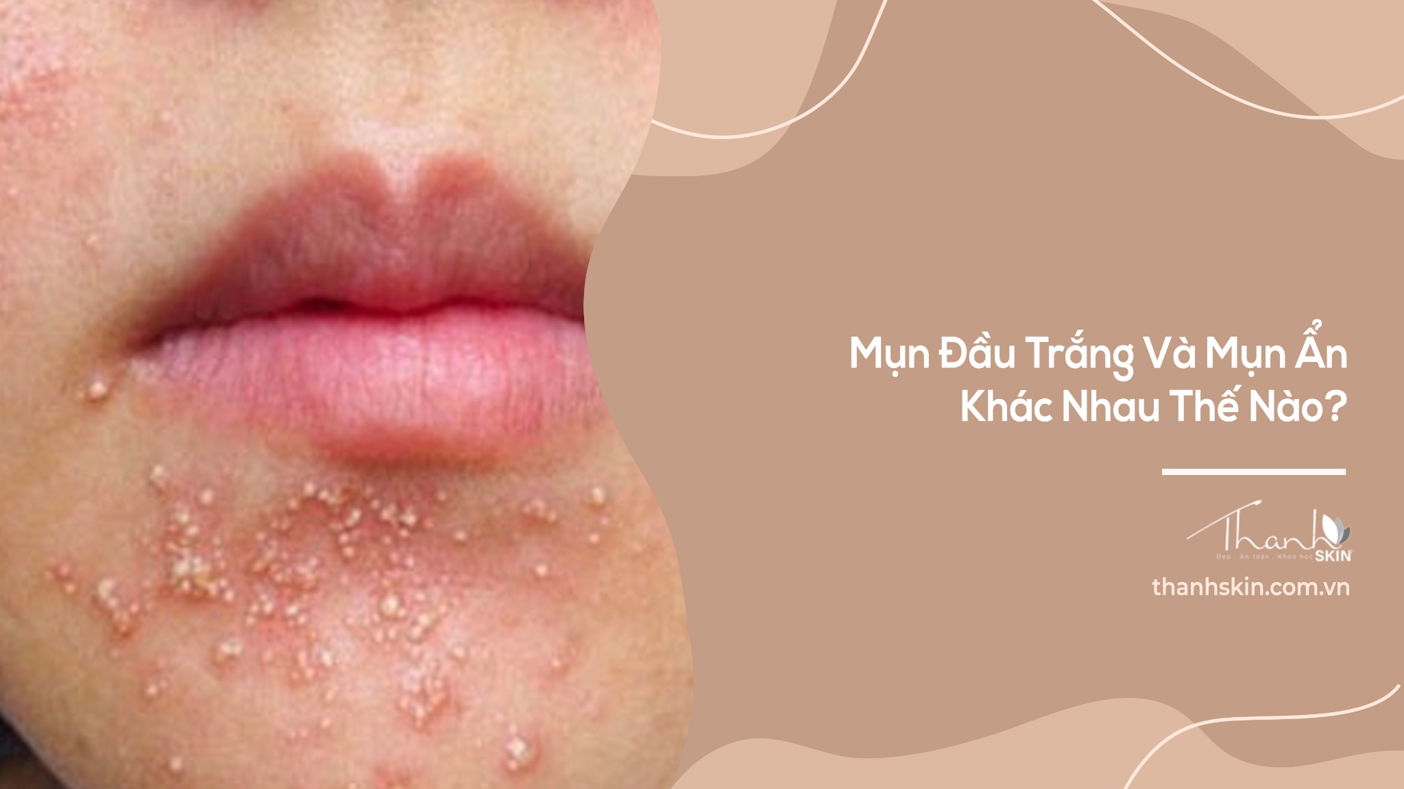 Mụn Đầu Trắng Và Mụn Ẩn Khác Nhau Thế Nào?