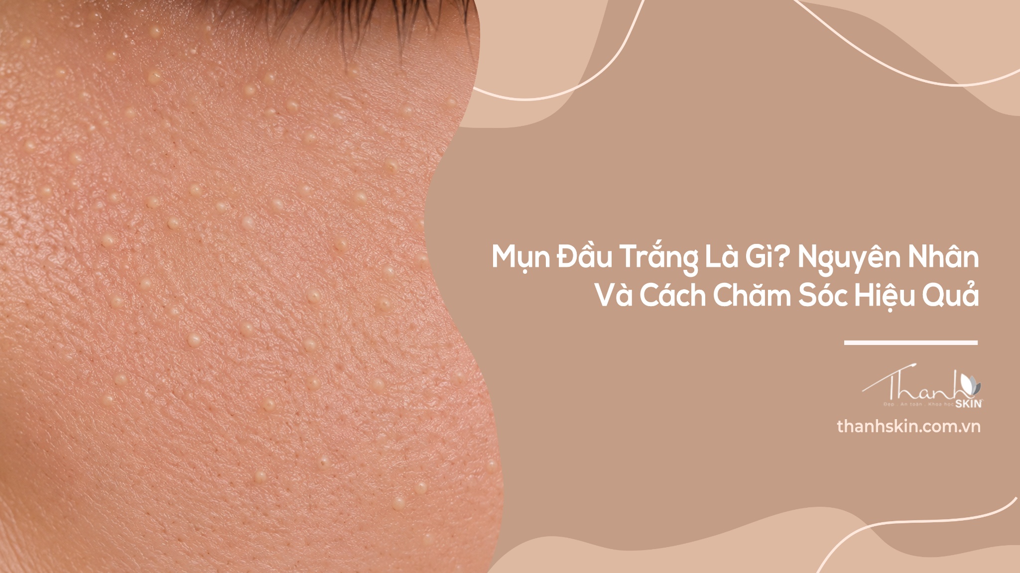 Mụn Đầu Trắng Là Gì? Nguyên Nhân Và Cách Chăm Sóc Hiệu Quả