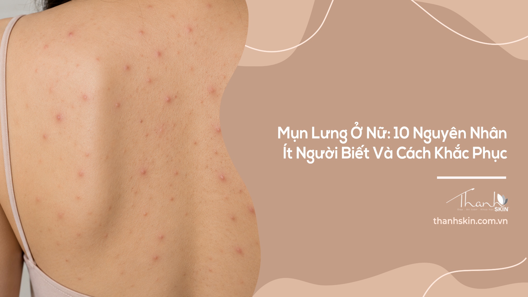 Mụn Lưng Ở Nữ: 10 Nguyên Nhân Ít Người Biết Và Cách Khắc Phục
