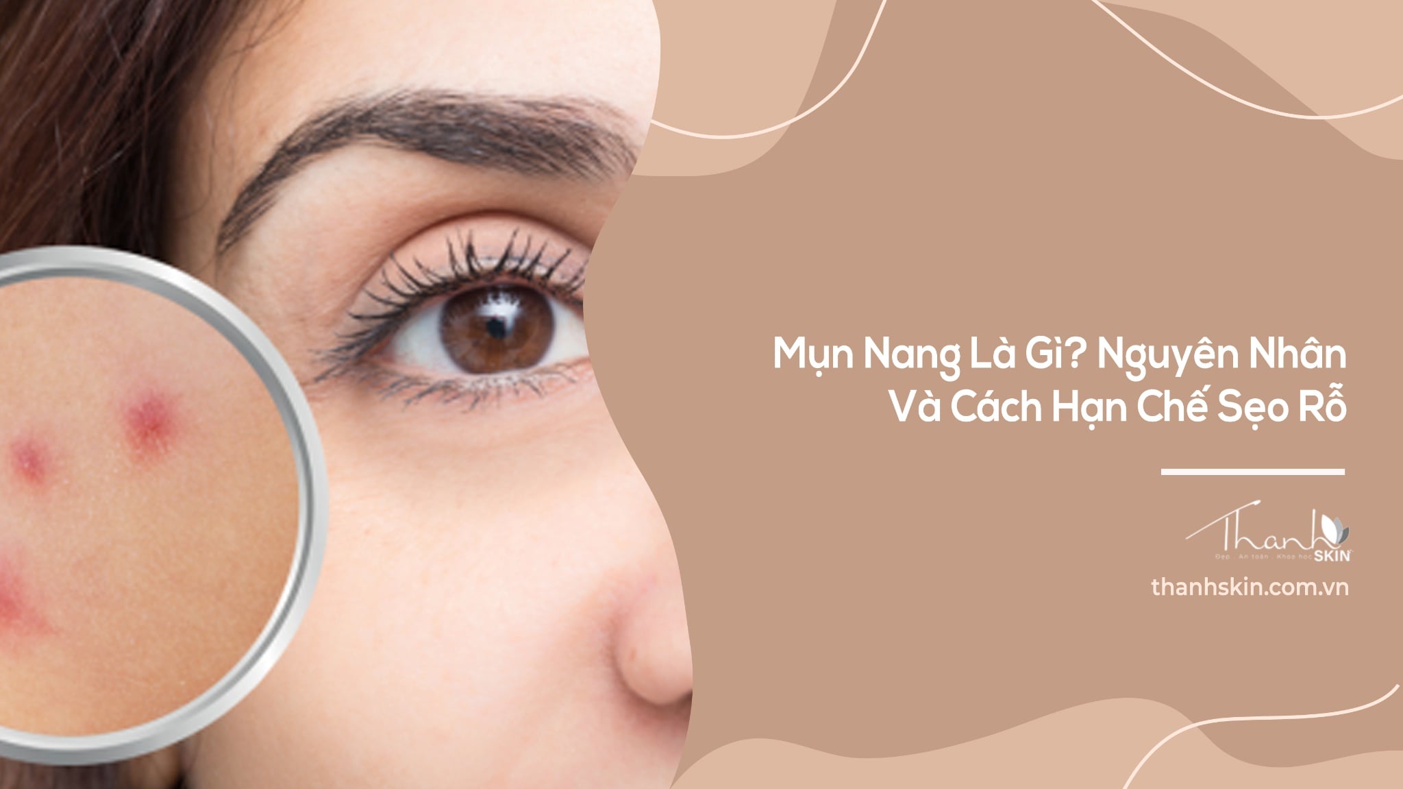 Mụn Nang Là Gì? Nguyên Nhân Và Cách Hạn Chế Sẹo Rỗ