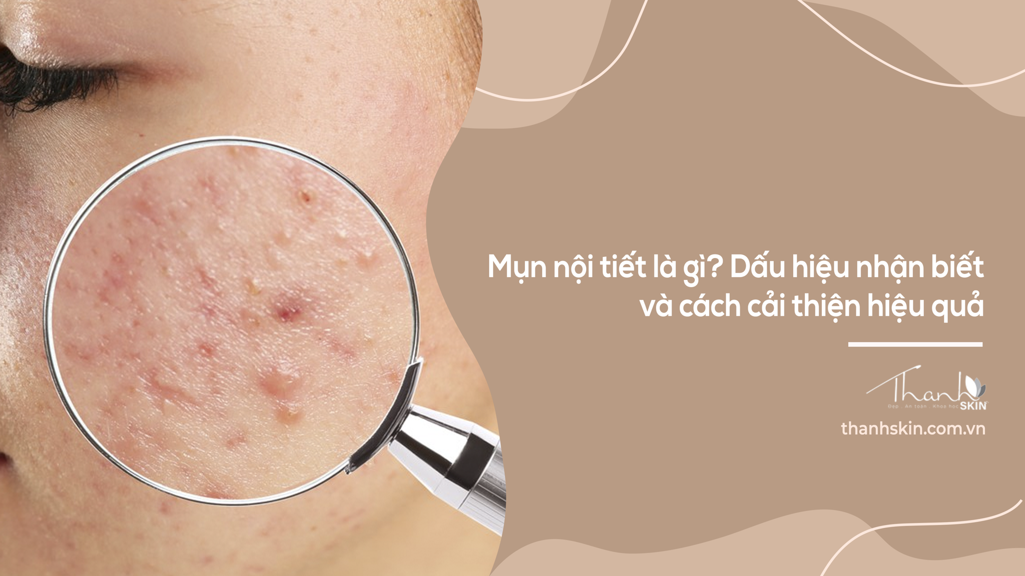 Mụn nội tiết là gì? Dấu hiệu nhận biết và cách cải thiện hiệu quả