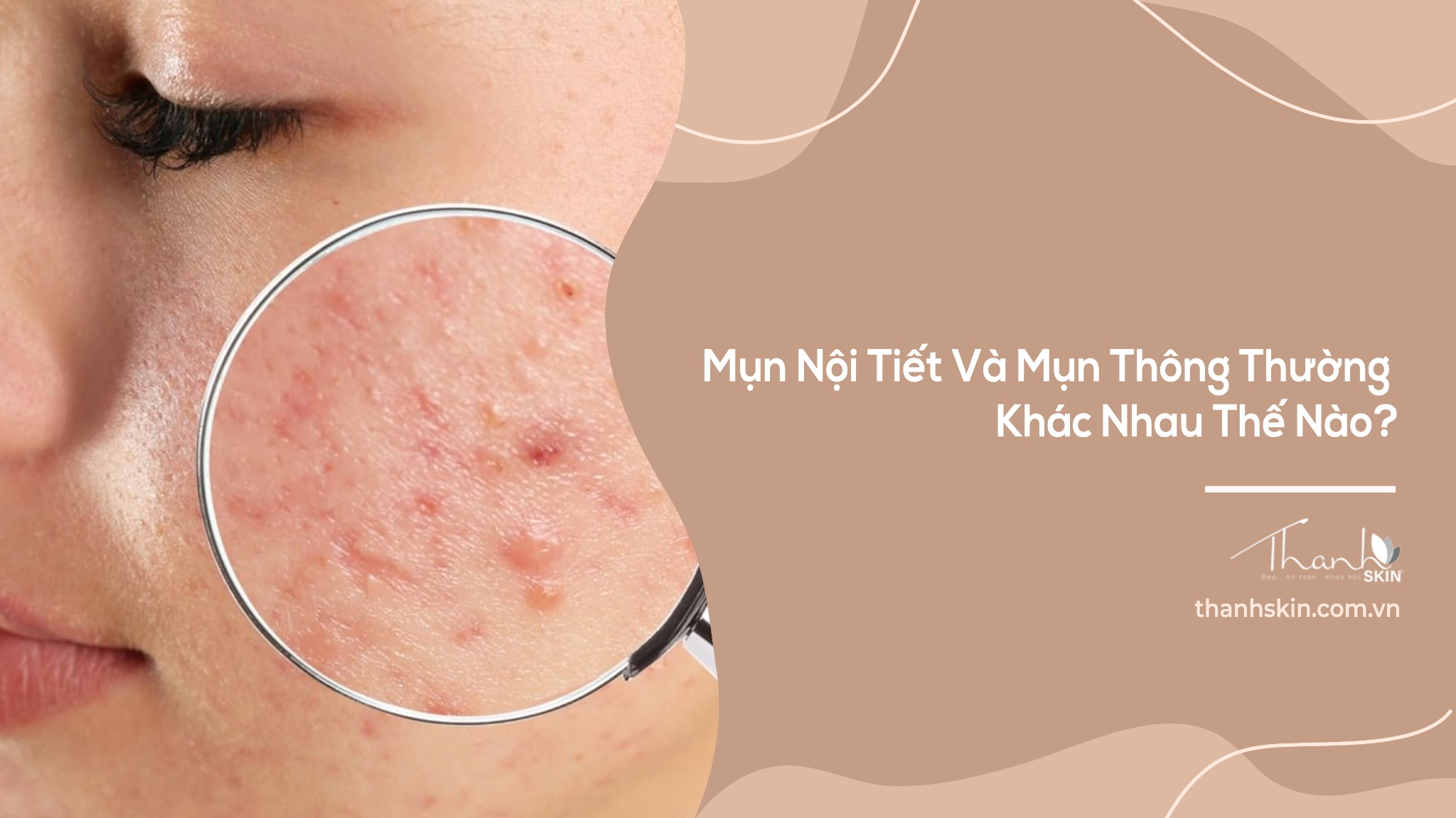 Mụn Nội Tiết Và Mụn Thường Khác Nhau Như Thế Nào?