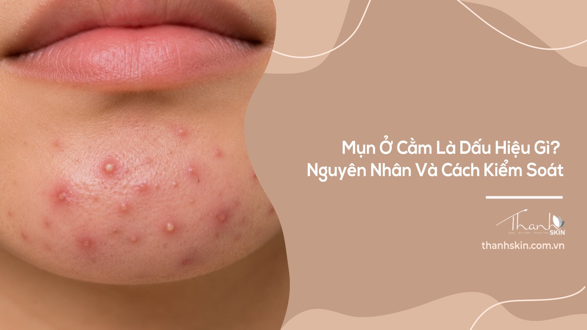 Mụn Ở Cằm Là Dấu Hiệu Gì? Nguyên Nhân Và Cách Kiểm Soát