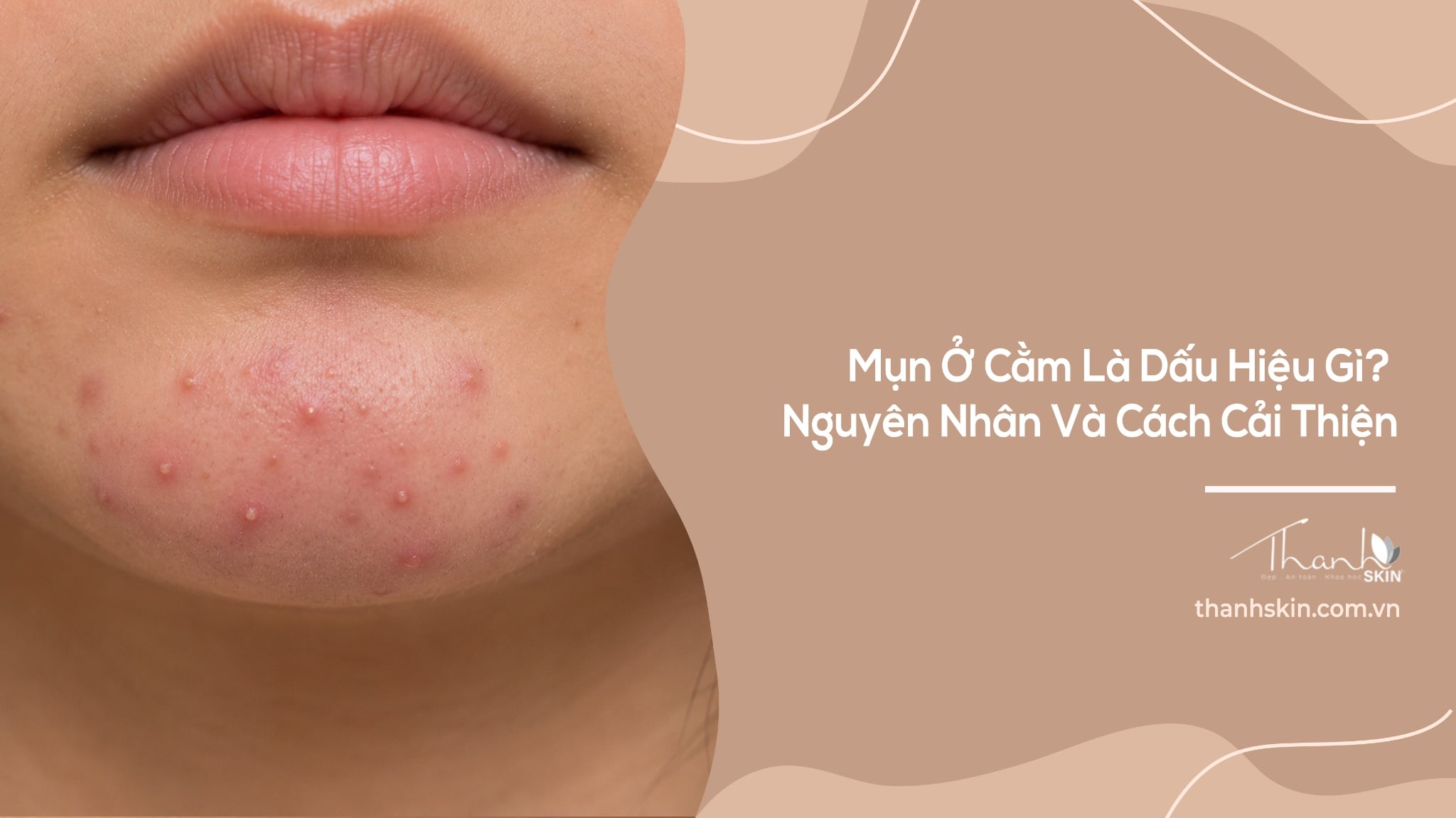 Mụn Ở Cằm Là Dấu Hiệu Gì? 7 Nguyên Nhân Thường Gặp