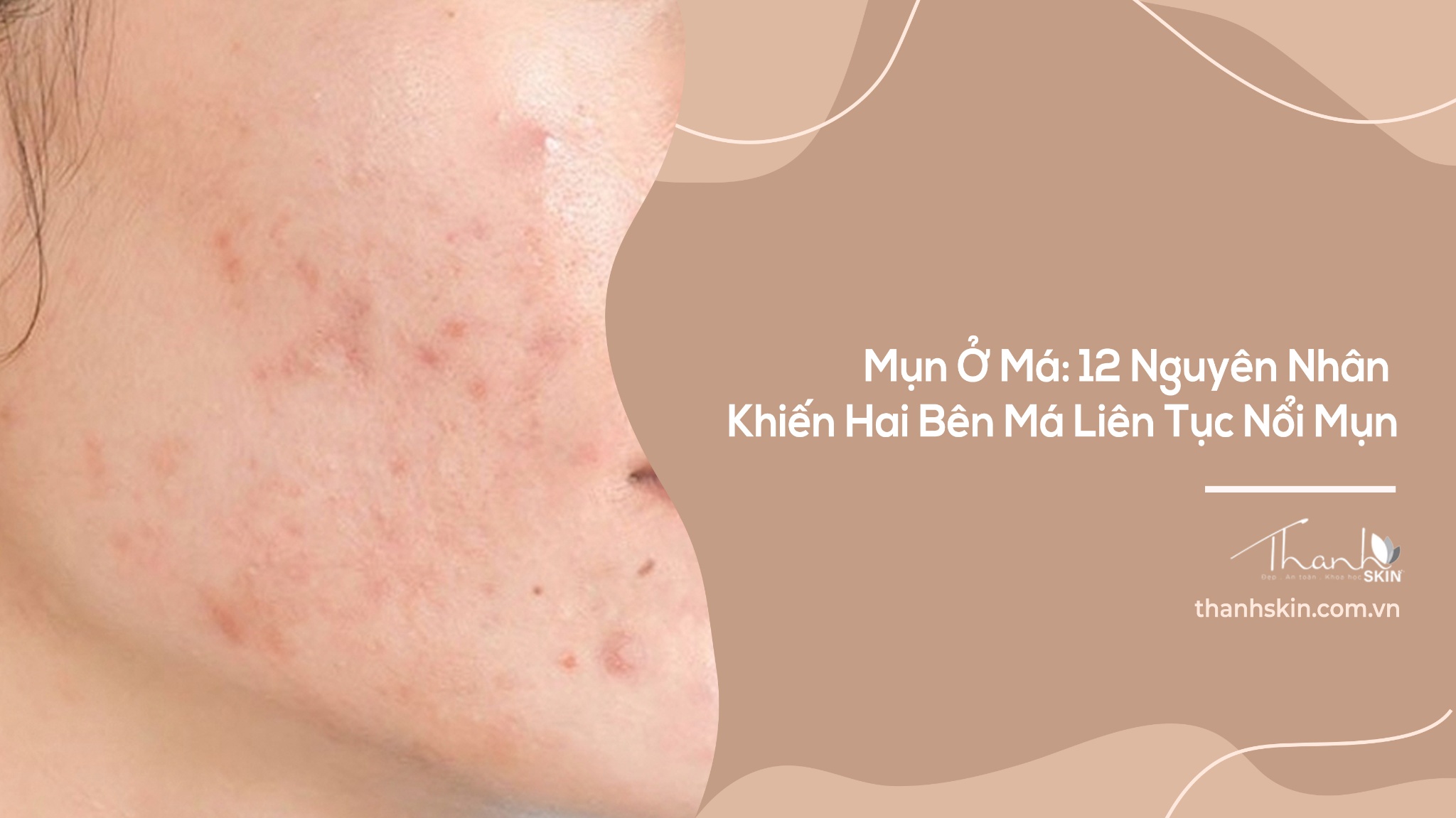 Mụn Ở Má: 12 Nguyên Nhân Khiến Hai Bên Má Liên Tục Nổi Mụn