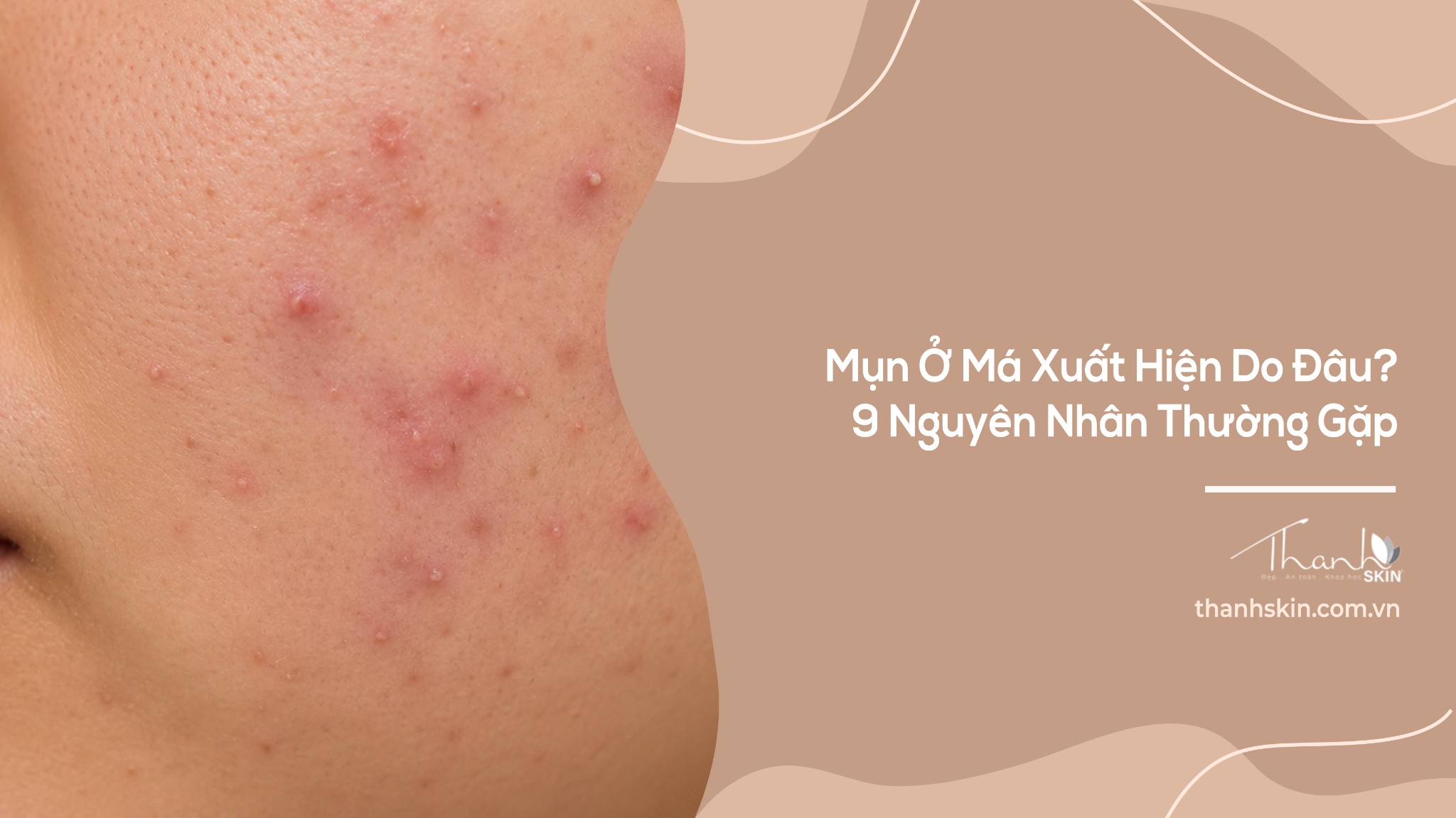 Mụn Ở Má Xuất Hiện Do Đâu? 9 Nguyên Nhân Thường Gặp