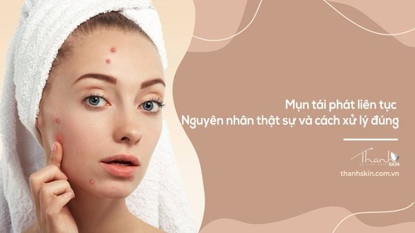 Mụn tái phát liên tục – Nguyên nhân thật sự và cách xử lý đúng