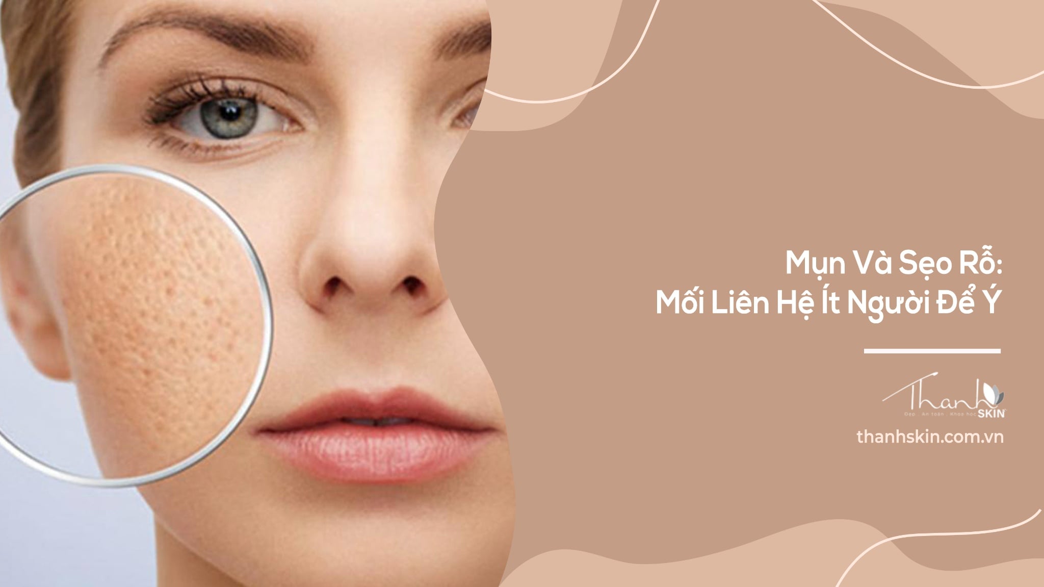Mụn Và Sẹo Rỗ: Mối Liên Hệ Ít Người Để Ý