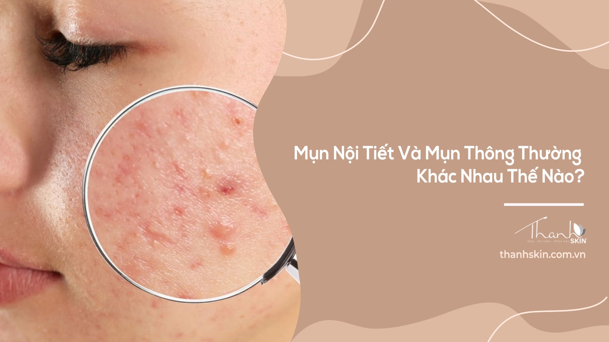 Mụn Nội Tiết Và Mụn Thông Thường Khác Nhau Thế Nào? Cách Nhận Biết Chính Xác