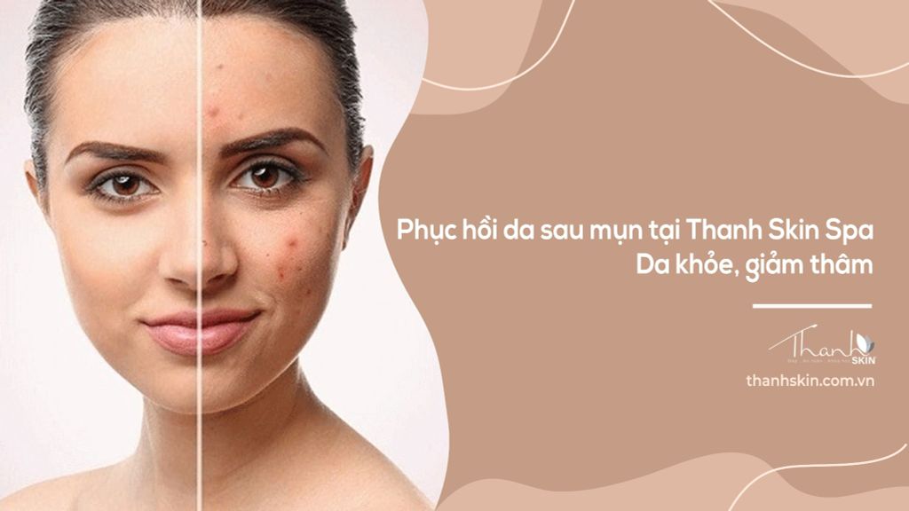 Phục hồi da sau mụn tại Thanh Skin Spa | Da khỏe, giảm thâm