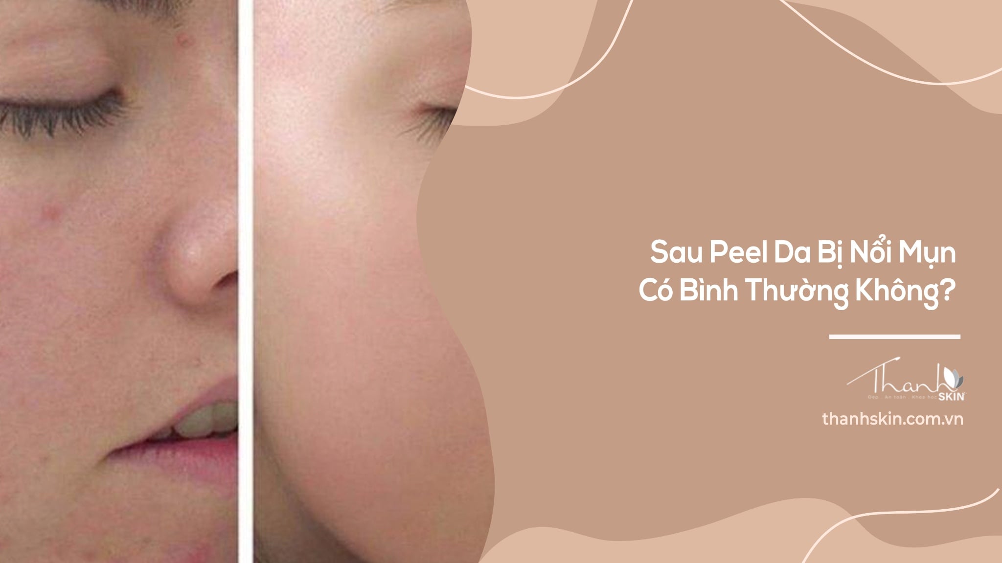 Sau Peel Da Bị Nổi Mụn Có Bình Thường Không? Cách Phân Biệt Đẩy Mụn Và Kích Ứng