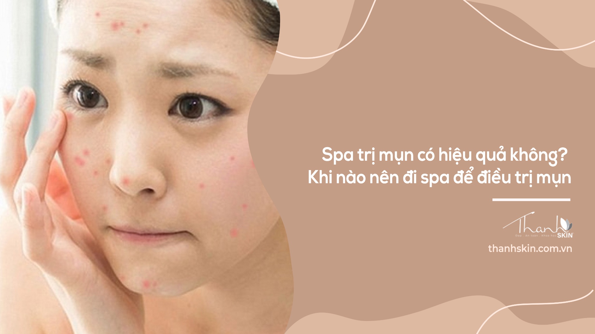 Spa trị mụn có hiệu quả không? Khi nào nên đi spa để điều trị mụn