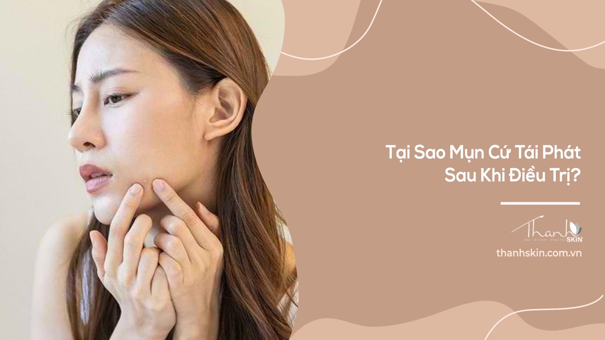 Tại Sao Mụn Cứ Tái Phát Sau Khi Điều Trị?