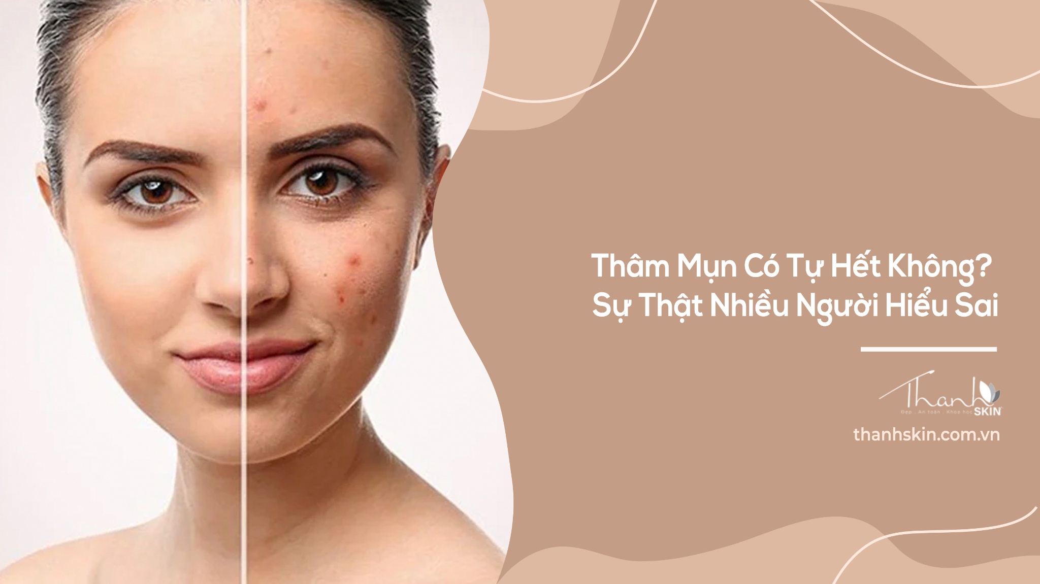 Thâm Mụn Có Tự Hết Không? Sự Thật Nhiều Người Hiểu Sai