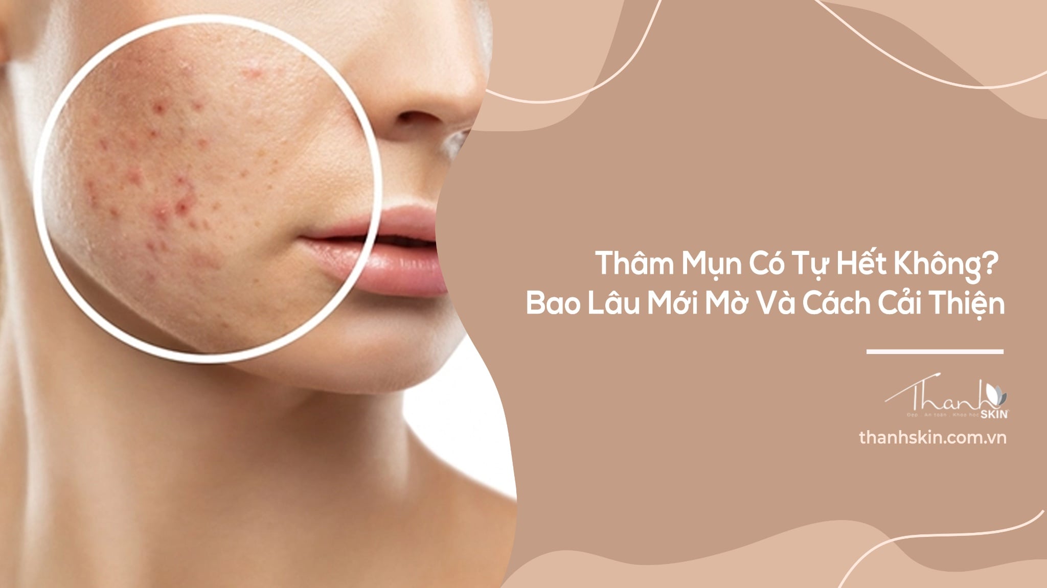 Thâm Mụn Có Tự Hết Không? Bao Lâu Mới Mờ Và Cách Cải Thiện
