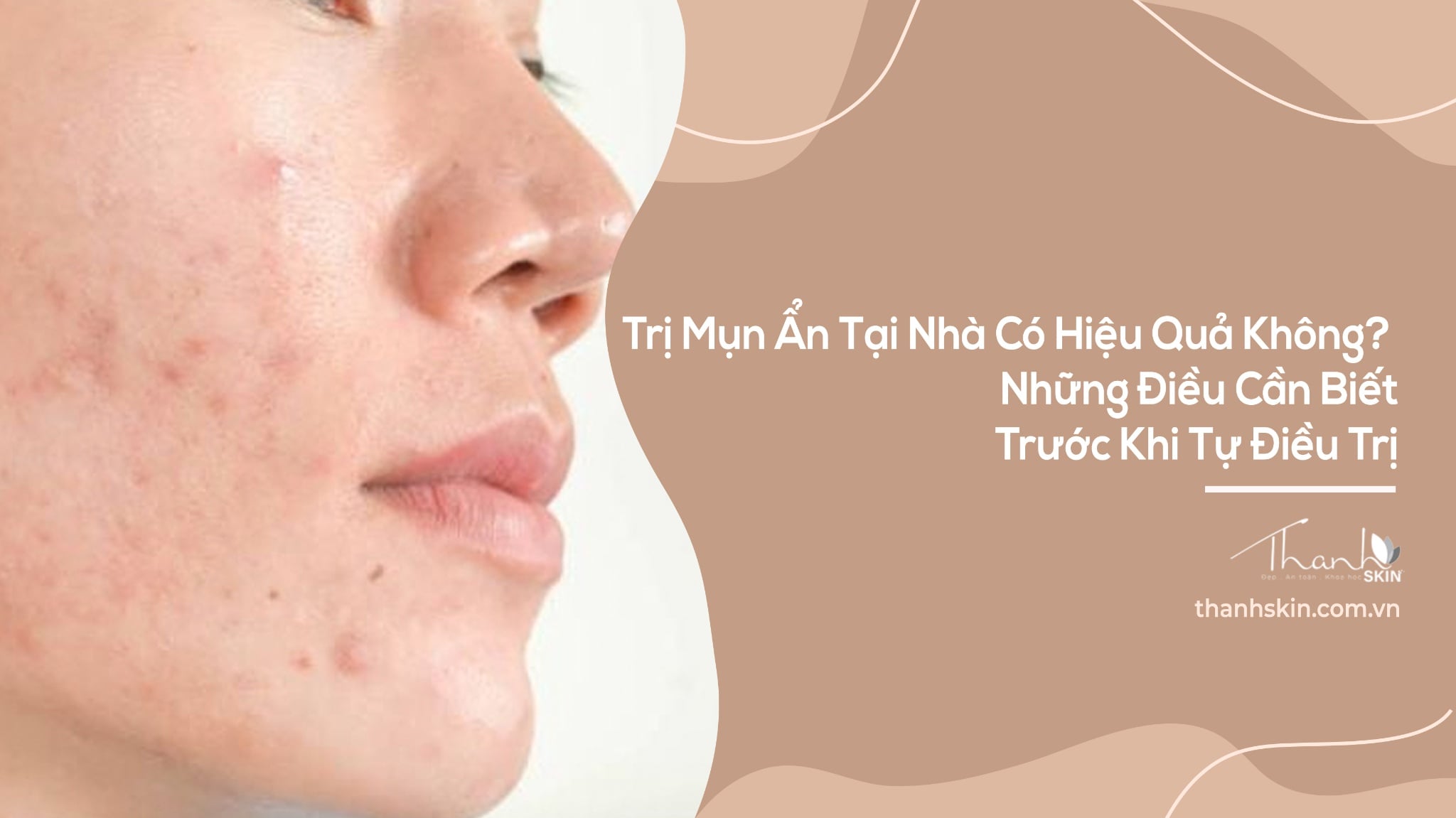 Trị Mụn Ẩn Tại Nhà Có Hiệu Quả Không? Những Điều Cần Biết Trước Khi Tự Điều Trị