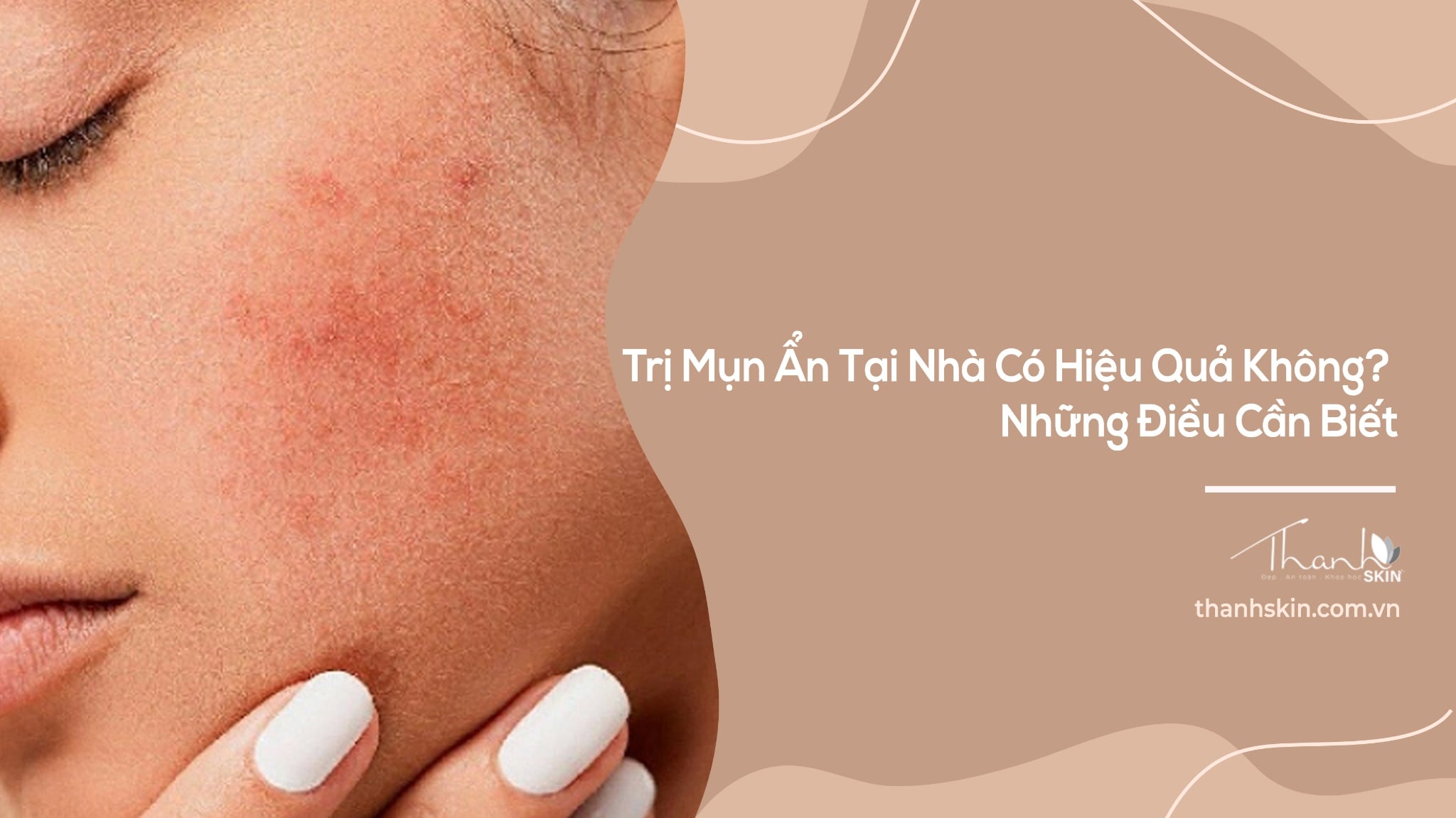 Trị Mụn Ẩn Tại Nhà Có Hiệu Quả Không? Những Điều Cần Biết