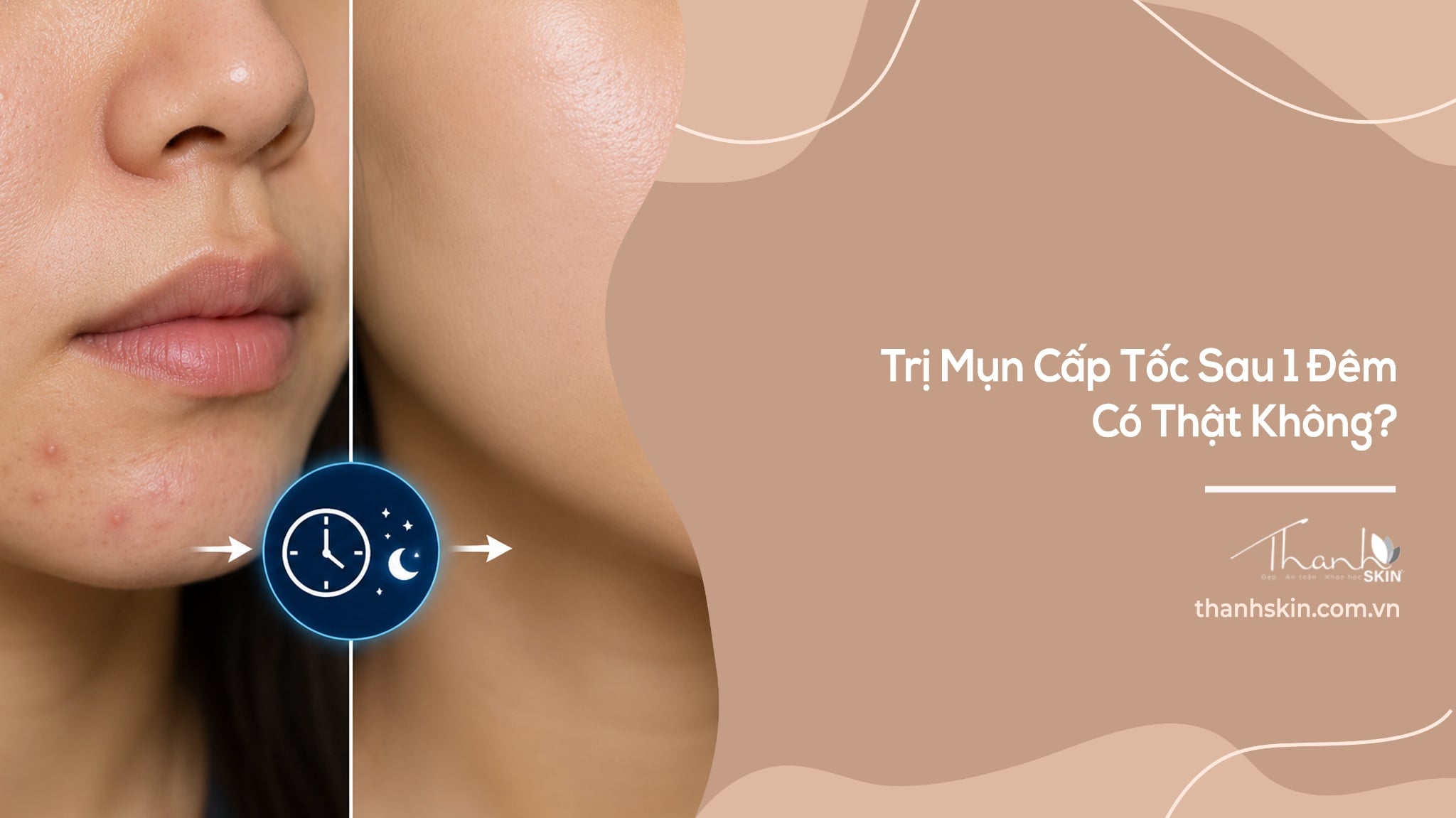 Trị Mụn Cấp Tốc Sau 1 Đêm Có Thật Không?