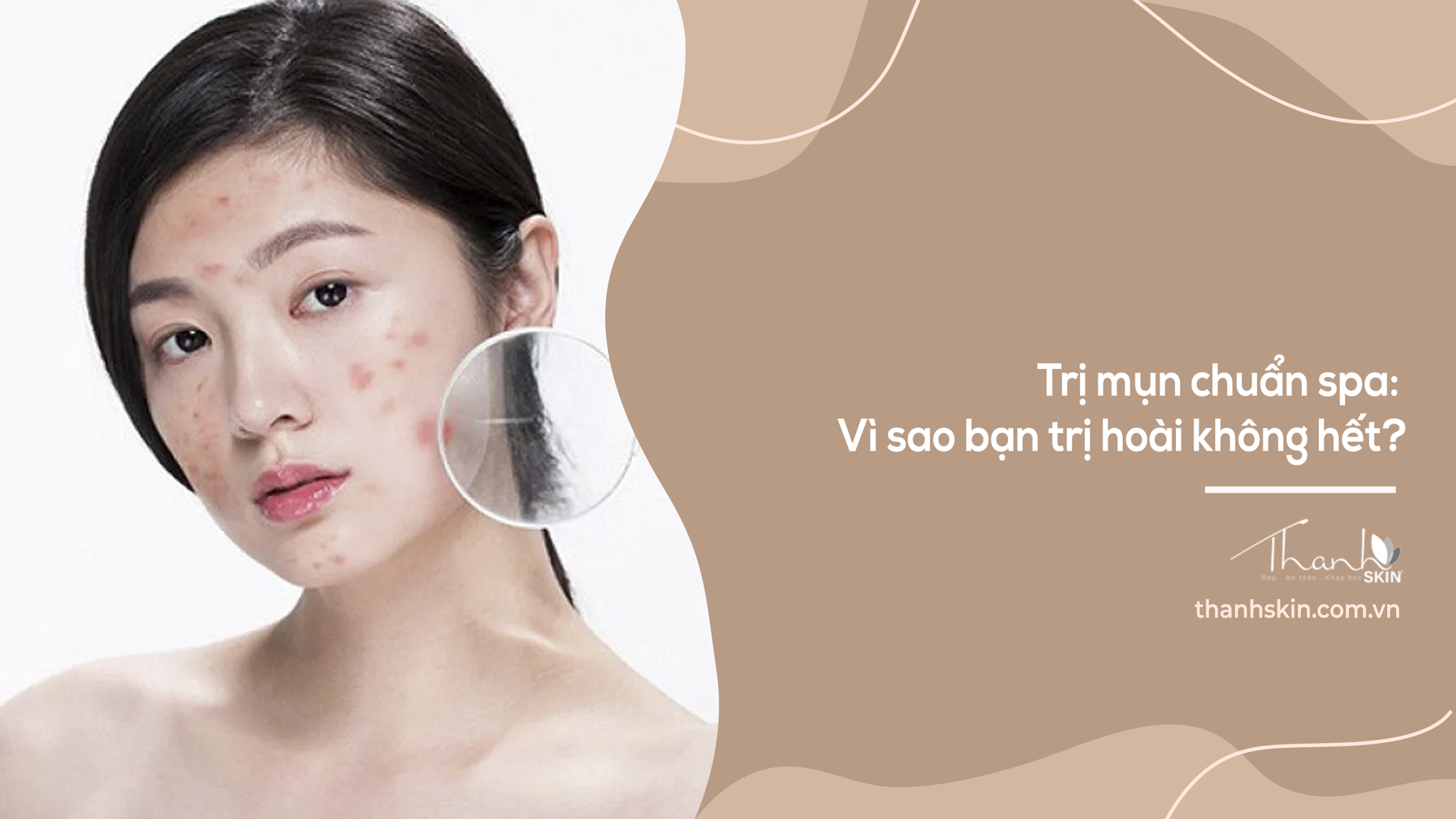 Trị mụn chuẩn spa: Vì sao bạn trị hoài không hết?