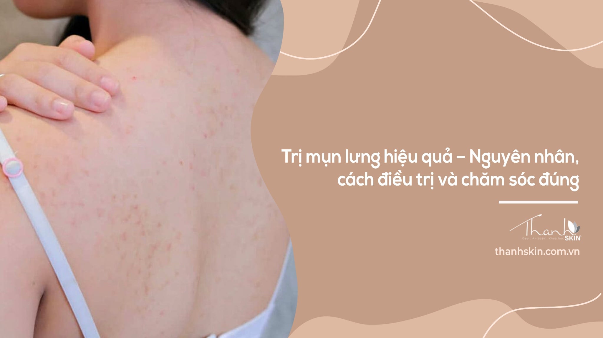 Trị Mụn Lưng Cho Nữ: Nguyên Nhân, Cách Chăm Sóc Và Những Sai Lầm Cần Tránh