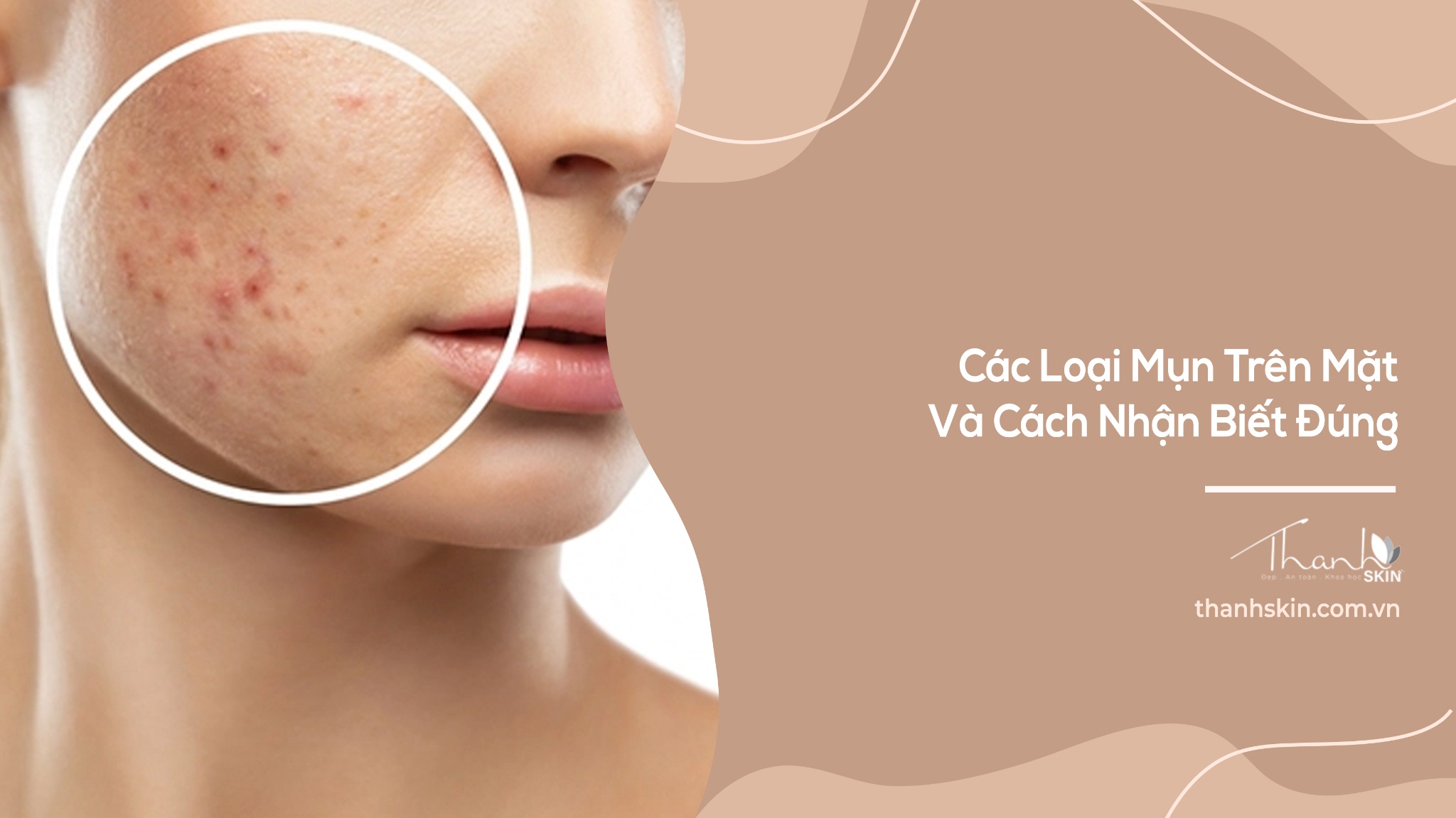 Các Loại Mụn Trên Mặt Và Cách Nhận Biết Đúng