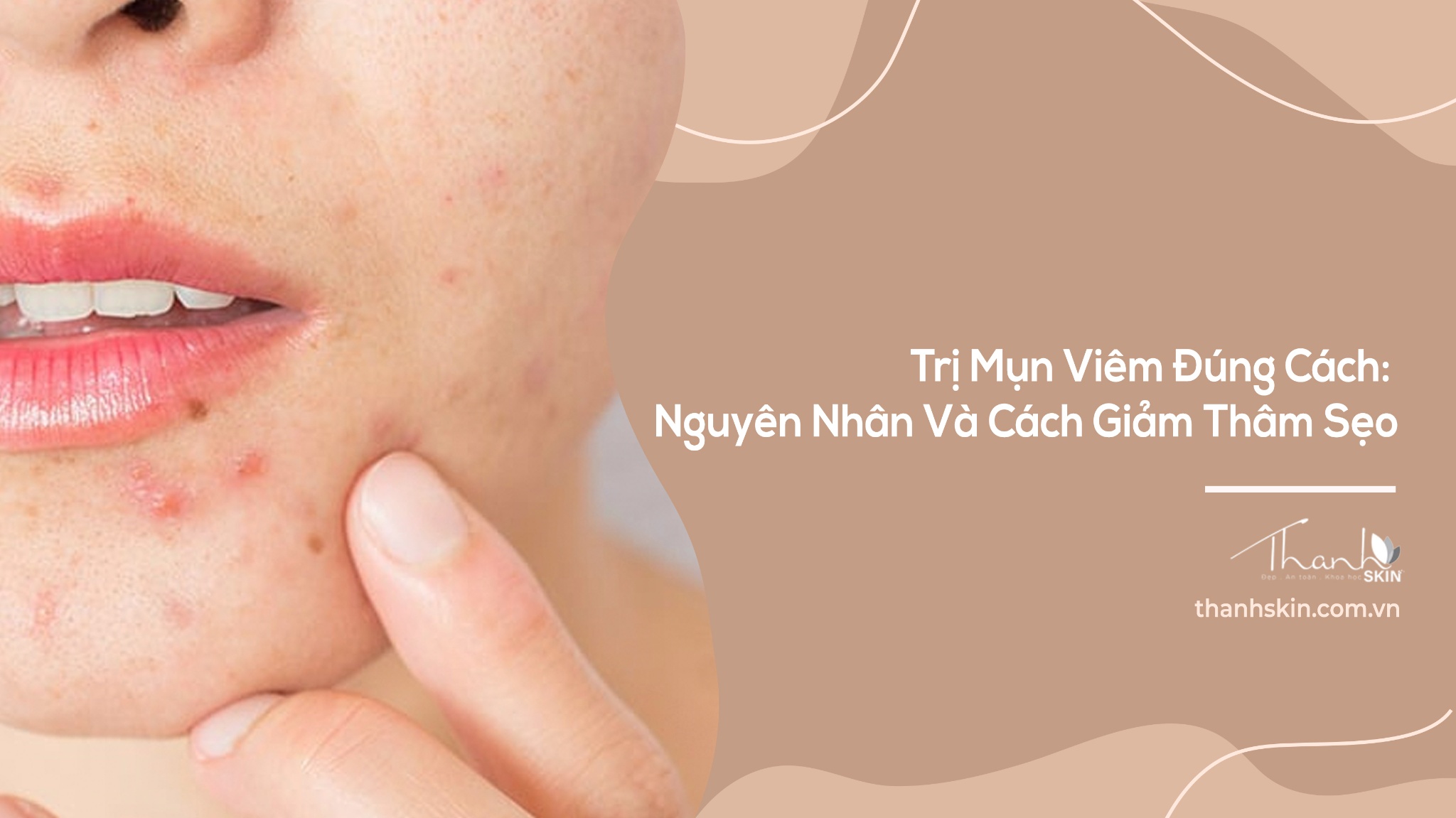 Trị Mụn Viêm Đúng Cách: Nguyên Nhân Và Cách Giảm Thâm Sẹo