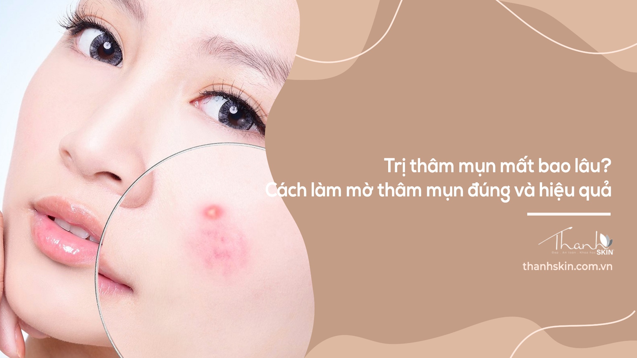 Trị thâm mụn mất bao lâu? Cách làm mờ thâm mụn đúng và hiệu quả