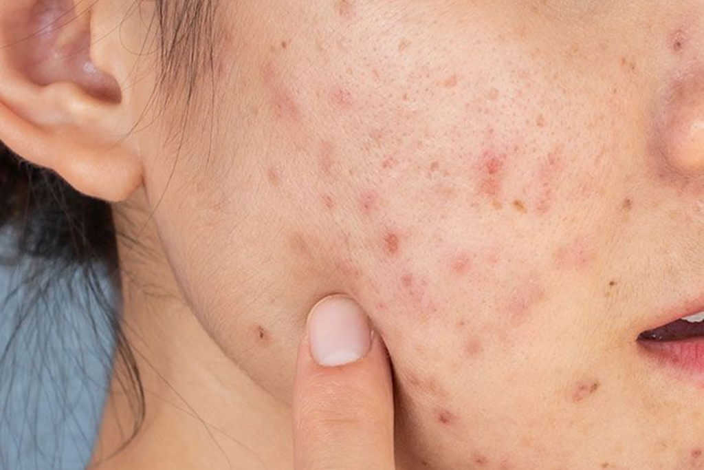 Cách Mềm Da, Mịn Da Cho Da Sần Sùi