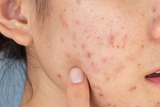 Cách Mềm Da, Mịn Da Cho Da Sần Sùi