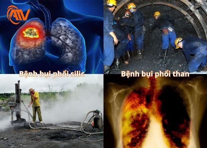 Bệnh bụi phổi silic và bệnh bụi phổi cần biết