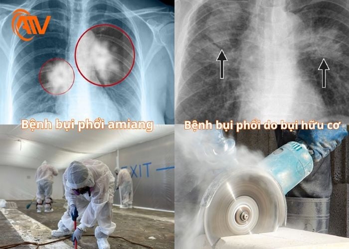 Bệnh bụi phổi amiang và bệnh bụi phổi do bụi hữu cơ