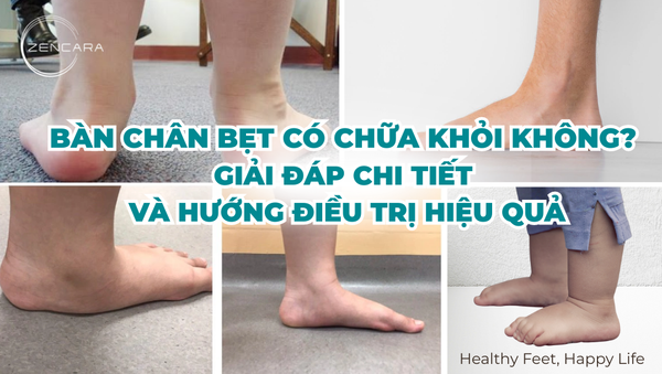 Bàn chân bẹt có chữa khỏi không? Giải đáp chi tiết và hướng điều trị hiệu quả