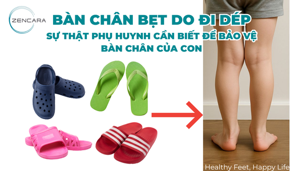 Bàn chân bẹt do đi dép: Sự thật phụ huynh cần biết để bảo vệ đôi bàn chân của con
