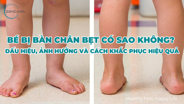 Bé bị bàn chân bẹt có sao không? Dấu hiệu, ảnh hưởng và cách khắc phục hiệu quả