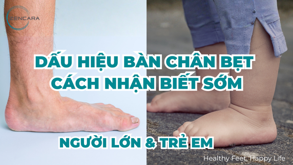 Dấu hiệu bàn chân bẹt: Cách nhận biết sớm ở trẻ em & người lớn